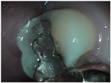 fractures with silver fillings